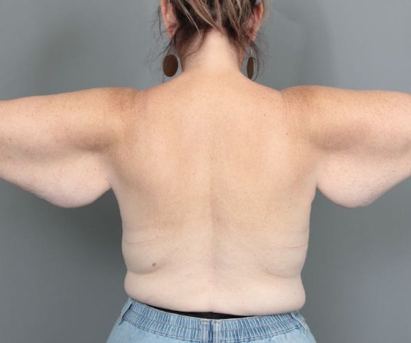 Arm Lift Before & After Gallery - Patient 381179 - Image 3 - Scott Chapin, MD