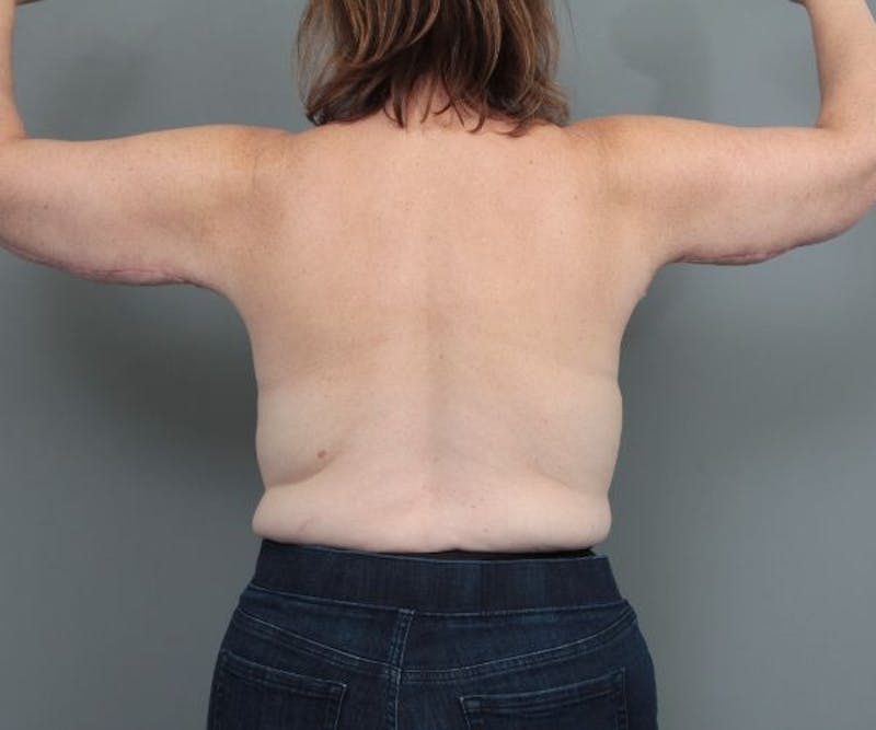 Arm Lift Before & After Gallery - Patient 381179 - Image 4 - Scott Chapin, MD