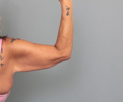 Arm Lift Before & After Gallery - Patient 165659 - Image 1 - Scott Chapin, MD