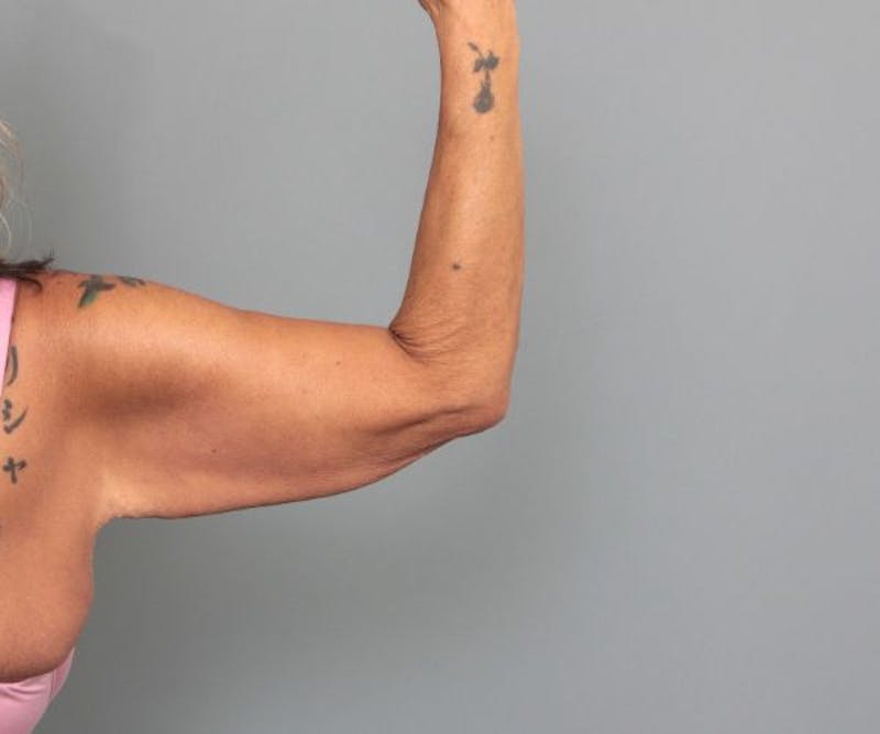 Arm Lift Before & After Gallery - Patient 165659 - Image 1 - Scott Chapin, MD