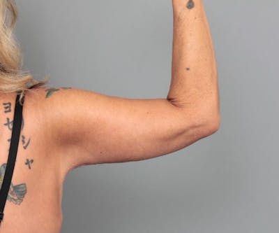 Arm Lift Before & After Gallery - Patient 165659 - Image 2 - Scott Chapin, MD