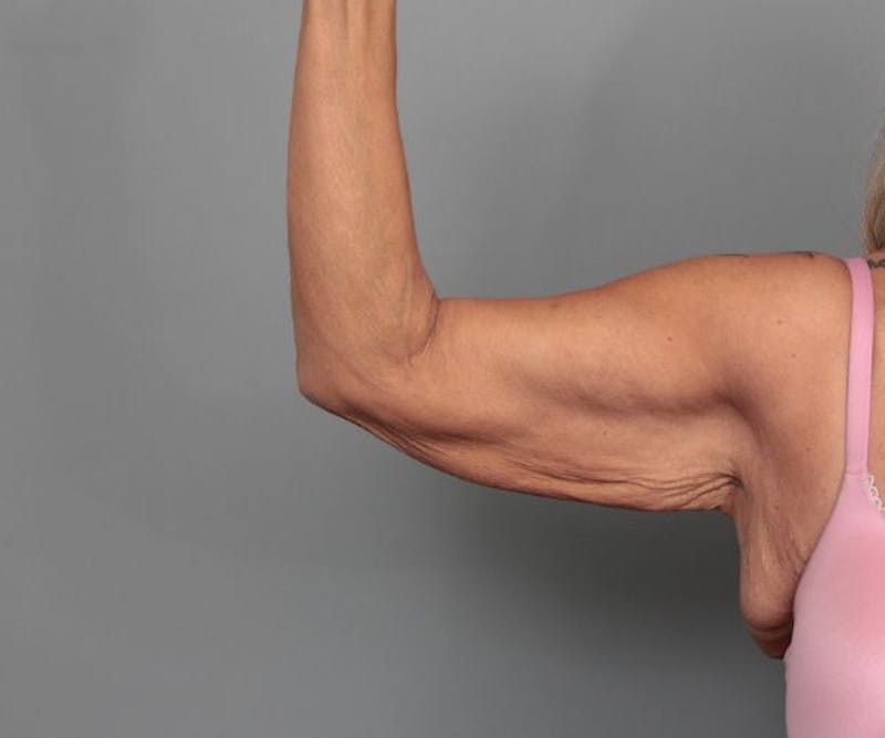 Arm Lift Before & After Gallery - Patient 165659 - Image 3 - Scott Chapin, MD