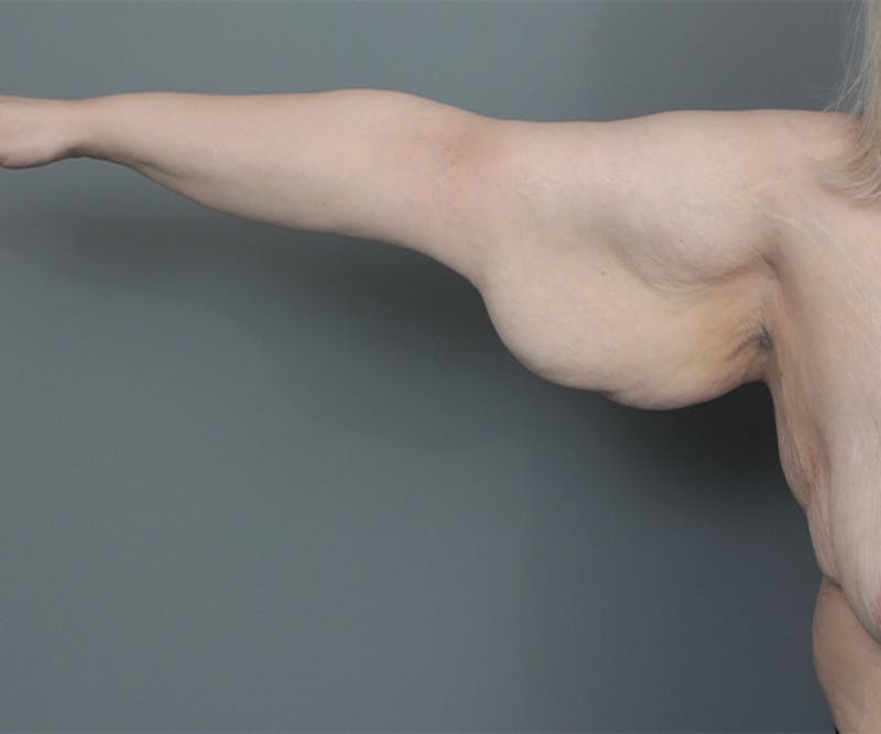 Arm Lift Before & After Gallery - Patient 349976 - Image 1 - Scott Chapin, MD