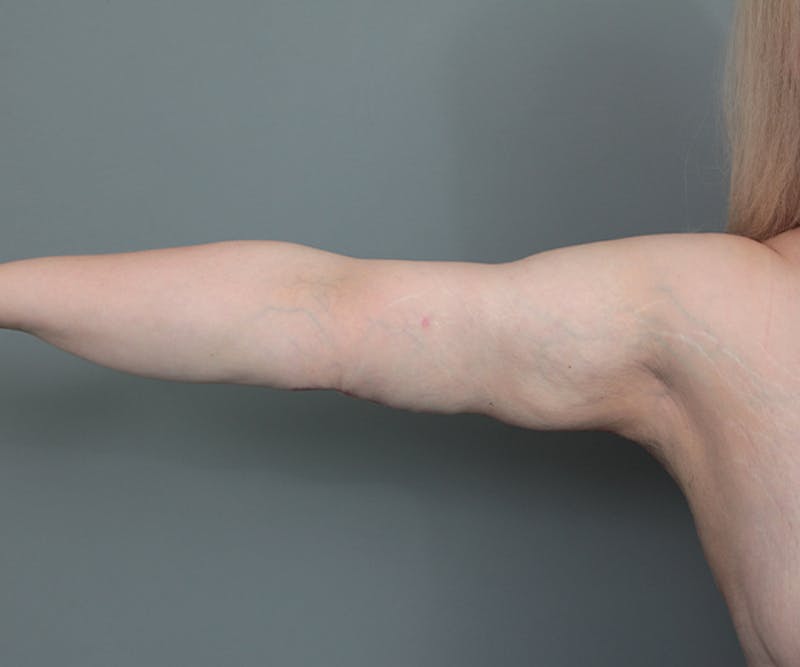 Arm Lift Before & After Gallery - Patient 349976 - Image 2 - Scott Chapin, MD