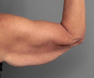 Arm Lift Before & After Gallery - Patient 234803 - Image 1 - Scott Chapin, MD