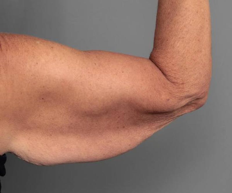 Arm Lift Before & After Gallery - Patient 234803 - Image 1 - Scott Chapin, MD
