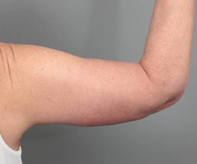 Arm Lift Before & After Gallery - Patient 234803 - Image 2 - Scott Chapin, MD