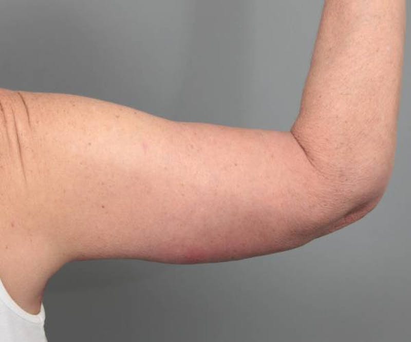 Arm Lift Before & After Gallery - Patient 234803 - Image 2 - Scott Chapin, MD