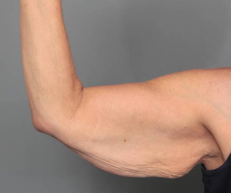 Arm Lift Before & After Gallery - Patient 234803 - Image 3 - Scott Chapin, MD