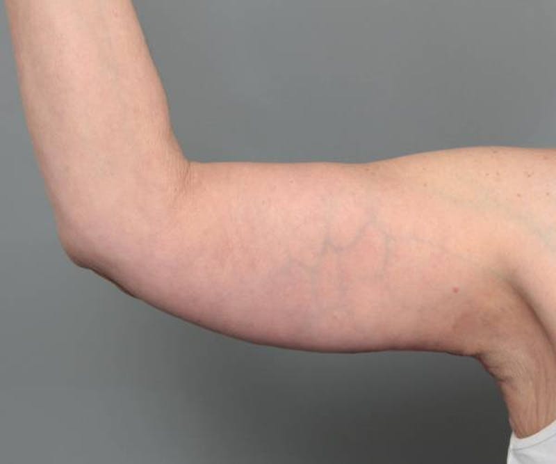 Arm Lift Before & After Gallery - Patient 234803 - Image 4 - Scott Chapin, MD