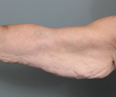 Arm Lift Before & After Gallery - Patient 990413 - Image 1 - Scott Chapin, MD