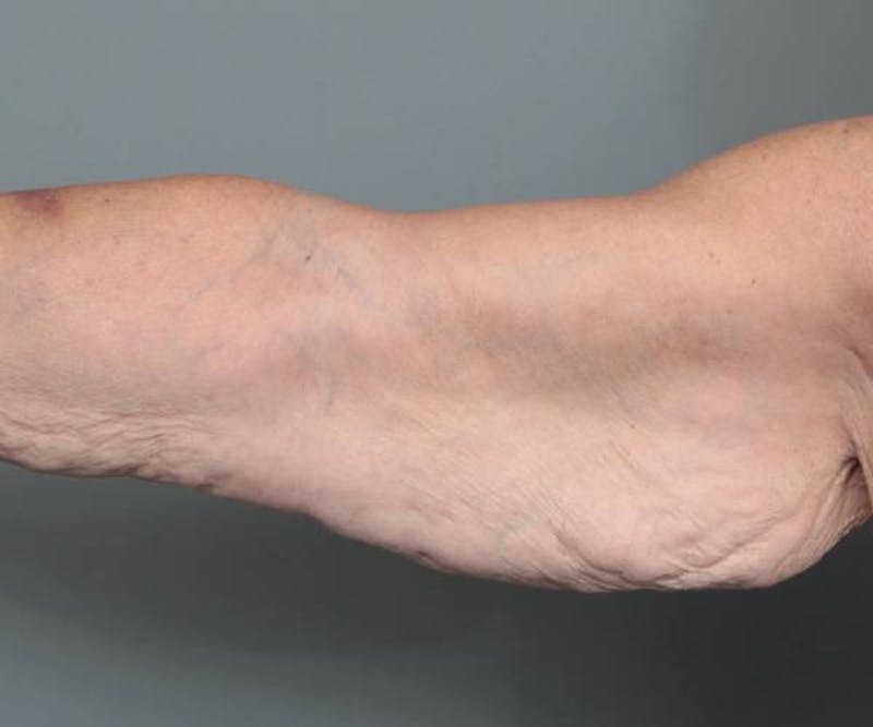 Arm Lift Before & After Gallery - Patient 990413 - Image 1 - Scott Chapin, MD
