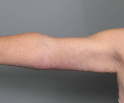 Arm Lift Before & After Gallery - Patient 990413 - Image 2 - Scott Chapin, MD