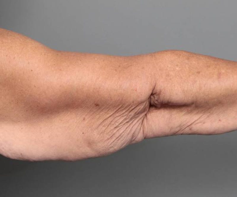 Arm Lift Before & After Gallery - Patient 990413 - Image 3 - Scott Chapin, MD