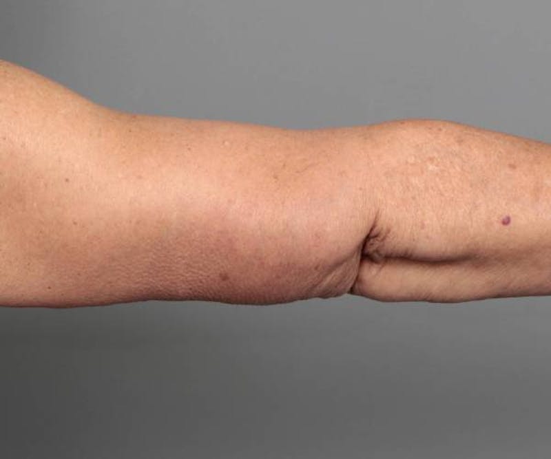 Arm Lift Before & After Gallery - Patient 990413 - Image 4 - Scott Chapin, MD