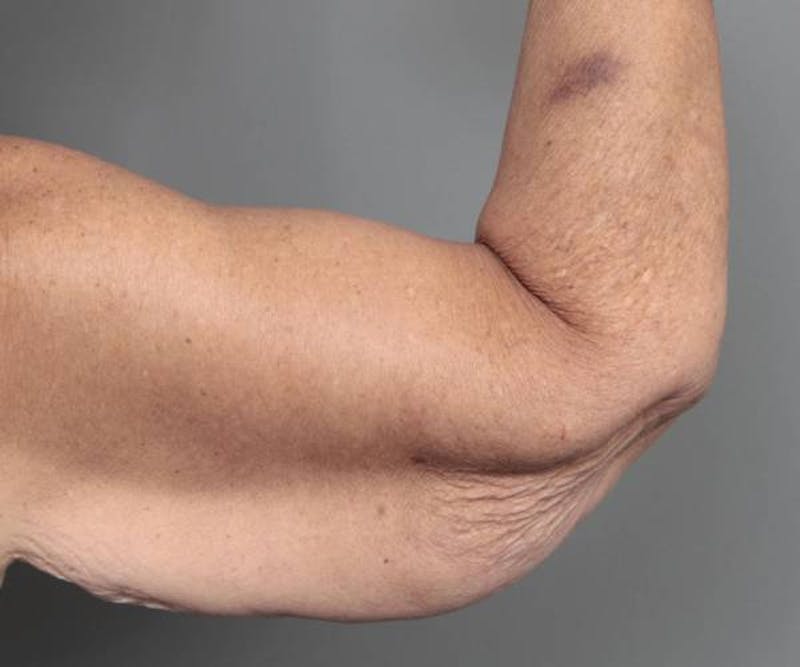 Arm Lift Before & After Gallery - Patient 990413 - Image 5 - Scott Chapin, MD