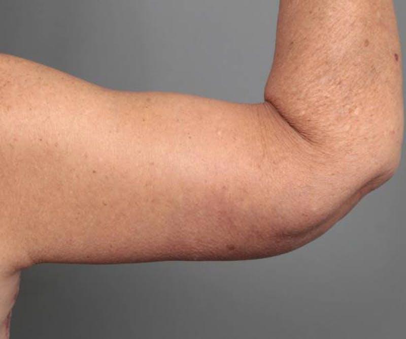 Arm Lift Before & After Gallery - Patient 990413 - Image 6 - Scott Chapin, MD