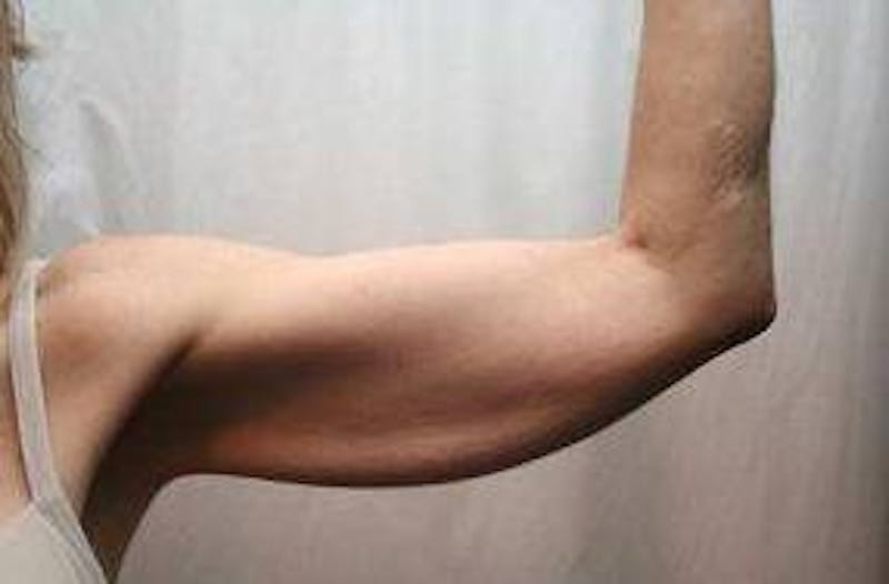 Arm Lift Before & After Gallery - Patient 735101 - Image 1 - Scott Chapin, MD