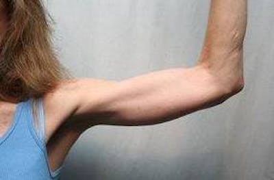 Arm Lift Before & After Gallery - Patient 735101 - Image 2 - Scott Chapin, MD