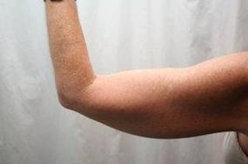 Arm Lift Before & After Gallery - Patient 735101 - Image 3 - Scott Chapin, MD