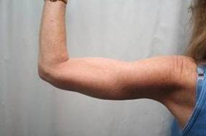 Arm Lift Before & After Gallery - Patient 735101 - Image 4 - Scott Chapin, MD