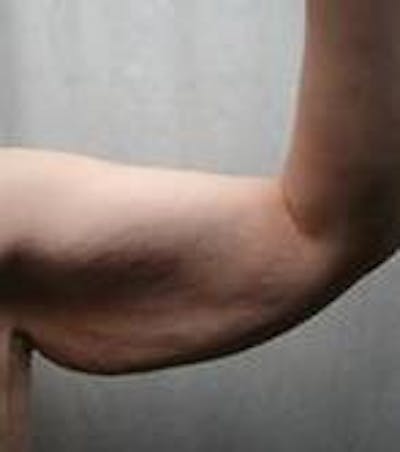 Arm Lift Before & After Gallery - Patient 342757 - Image 1 - Scott Chapin, MD