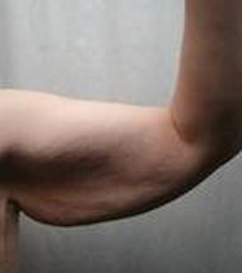 Arm Lift Before & After Gallery - Patient 342757 - Image 1 - Scott Chapin, MD