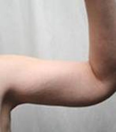 Arm Lift Before & After Gallery - Patient 342757 - Image 2 - Scott Chapin, MD