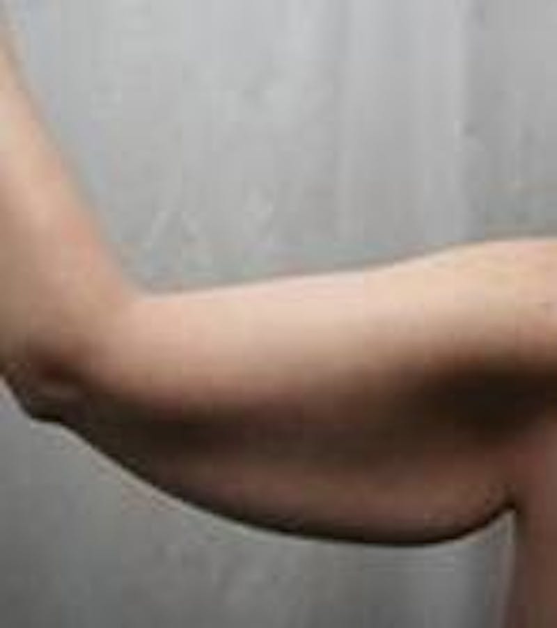Arm Lift Before & After Gallery - Patient 342757 - Image 3 - Scott Chapin, MD