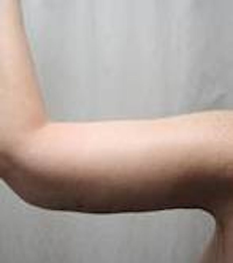 Arm Lift Before & After Gallery - Patient 342757 - Image 4 - Scott Chapin, MD