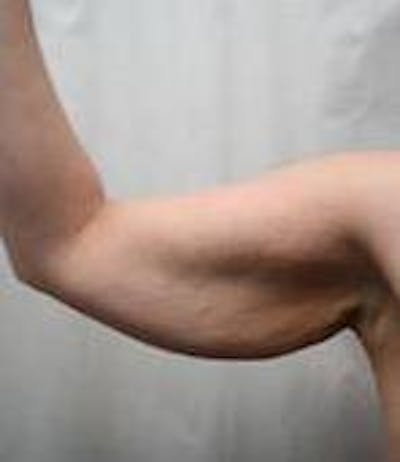 Arm Lift Before & After Gallery - Patient 152878 - Image 1 - Scott Chapin, MD