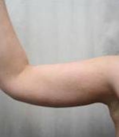 Arm Lift Before & After Gallery - Patient 152878 - Image 2 - Scott Chapin, MD