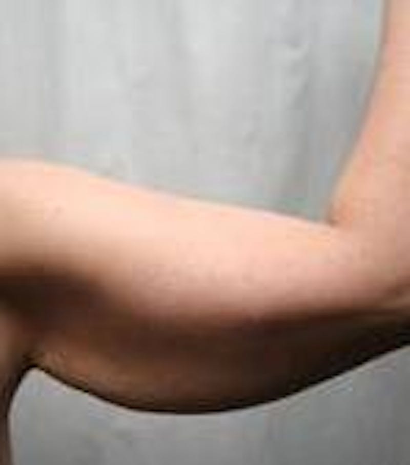 Arm Lift Before & After Gallery - Patient 152878 - Image 5 - Scott Chapin, MD