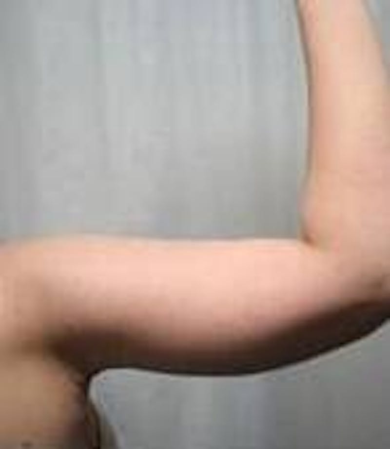 Arm Lift Before & After Gallery - Patient 152878 - Image 6 - Scott Chapin, MD