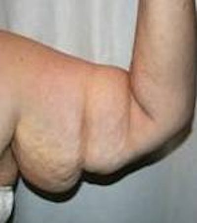 Arm Lift Before & After Gallery - Patient 743126 - Image 1 - Scott Chapin, MD