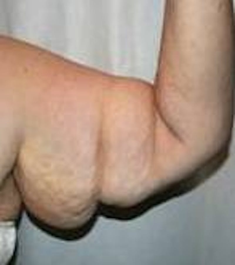 Arm Lift Before & After Gallery - Patient 743126 - Image 1 - Scott Chapin, MD