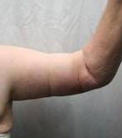 Arm Lift Before & After Gallery - Patient 743126 - Image 2 - Scott Chapin, MD