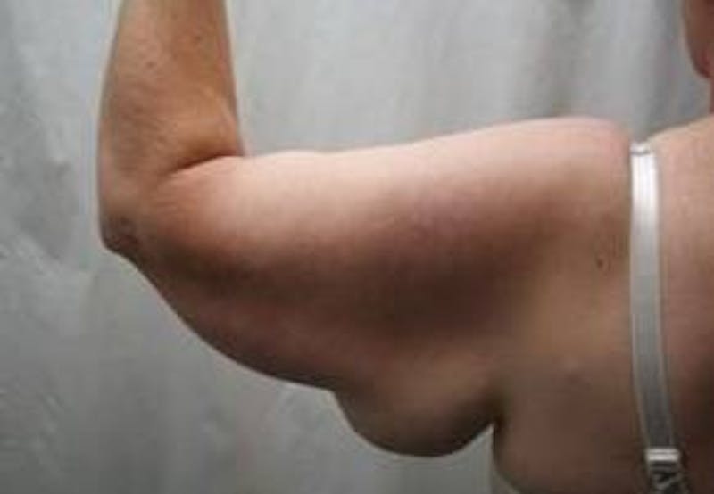 Arm Lift Before & After Gallery - Patient 743126 - Image 3 - Scott Chapin, MD