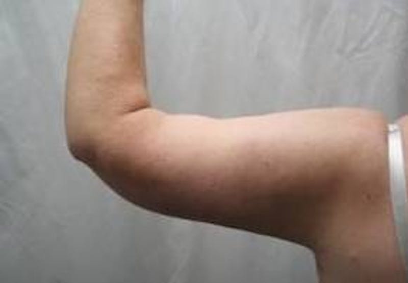 Arm Lift Before & After Gallery - Patient 743126 - Image 4 - Scott Chapin, MD