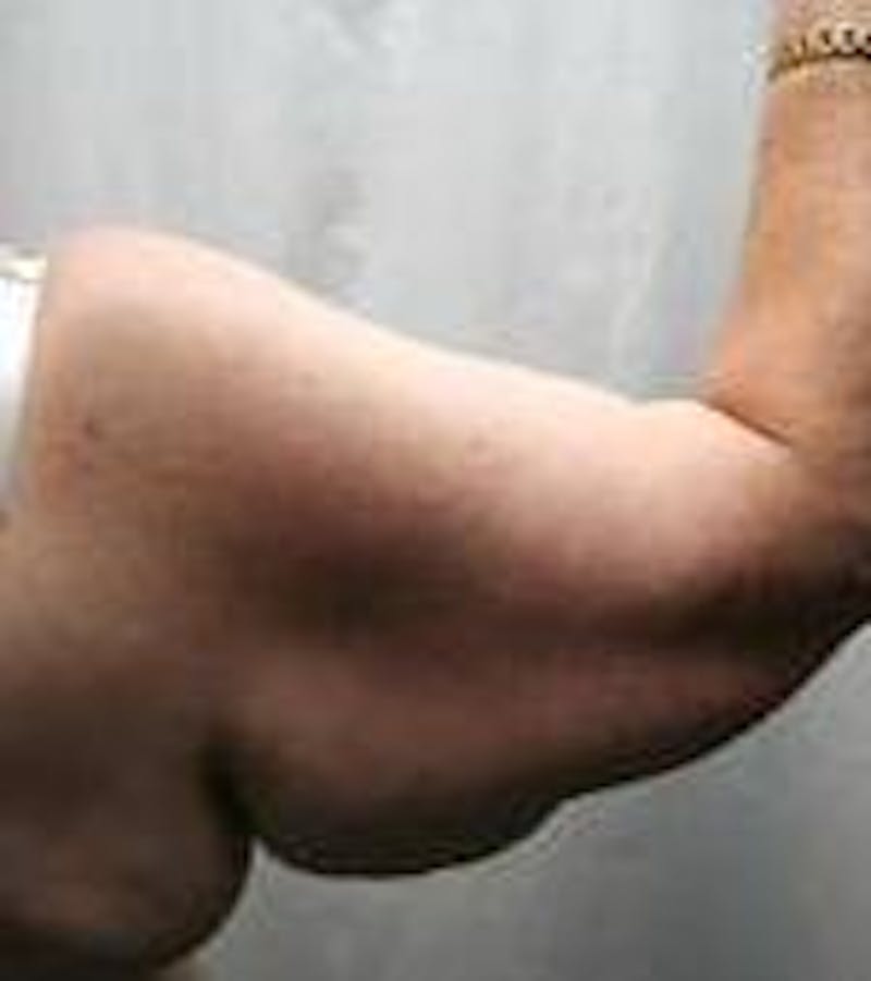Arm Lift Before & After Gallery - Patient 743126 - Image 5 - Scott Chapin, MD