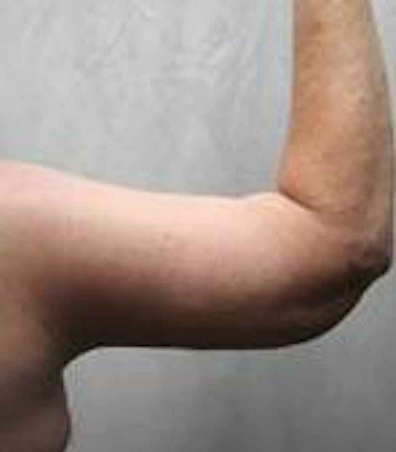 Arm Lift Before & After Gallery - Patient 743126 - Image 6 - Scott Chapin, MD
