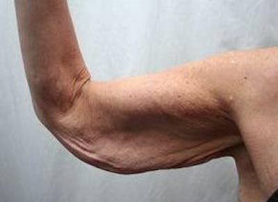 Arm Lift Before & After Gallery - Patient 306132 - Image 1 - Scott Chapin, MD