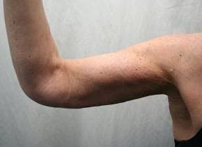 Arm Lift Before & After Gallery - Patient 306132 - Image 2 - Scott Chapin, MD