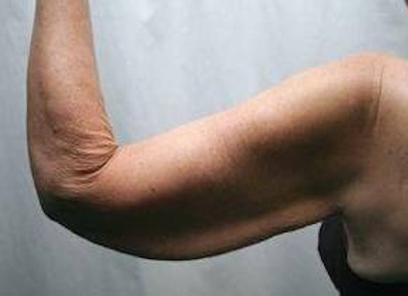 Arm Lift Before & After Gallery - Patient 306132 - Image 3 - Scott Chapin, MD