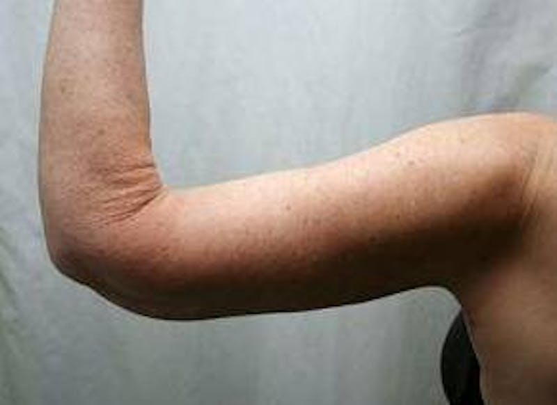 Arm Lift Before & After Gallery - Patient 306132 - Image 4 - Scott Chapin, MD