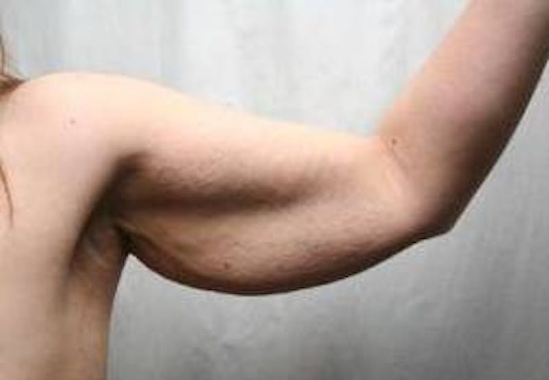 Arm Lift Before & After Gallery - Patient 236326 - Image 1 - Scott Chapin, MD