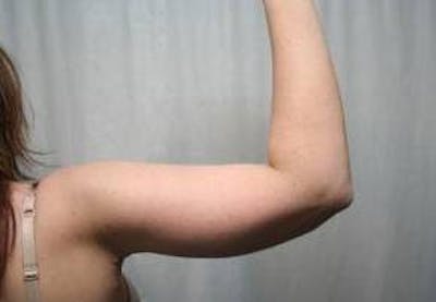 Arm Lift Before & After Gallery - Patient 236326 - Image 2 - Scott Chapin, MD