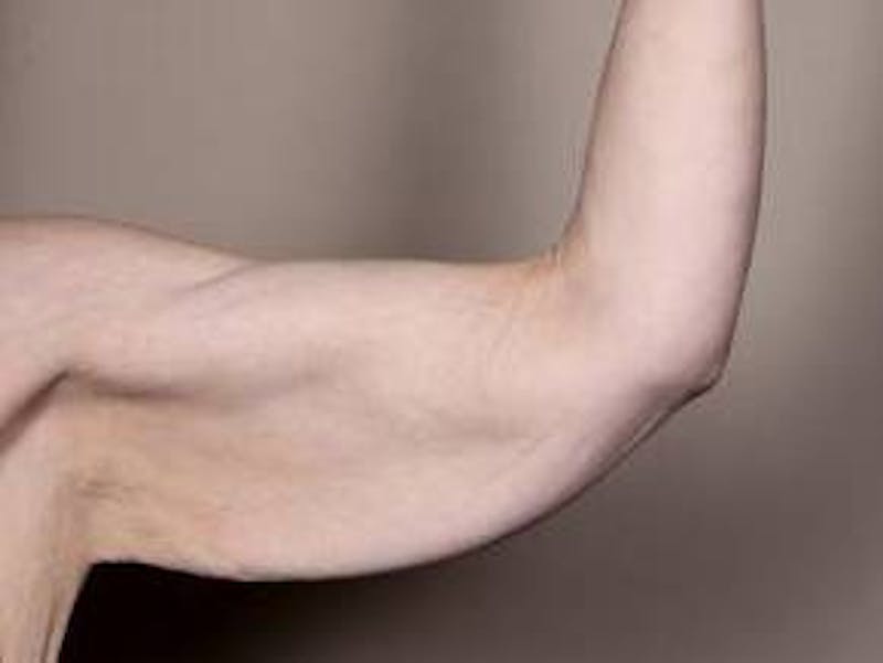 Arm Lift Before & After Gallery - Patient 350294 - Image 1 - Scott Chapin, MD