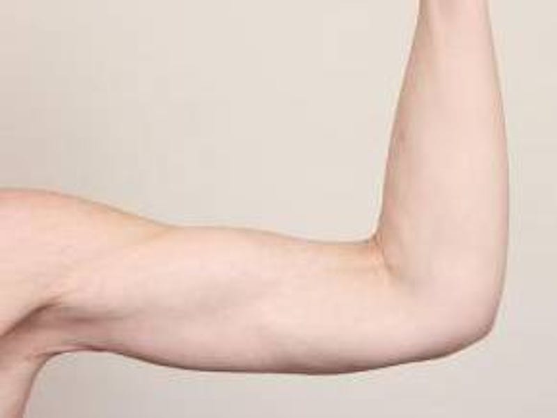 Arm Lift Before & After Gallery - Patient 350294 - Image 2 - Scott Chapin, MD