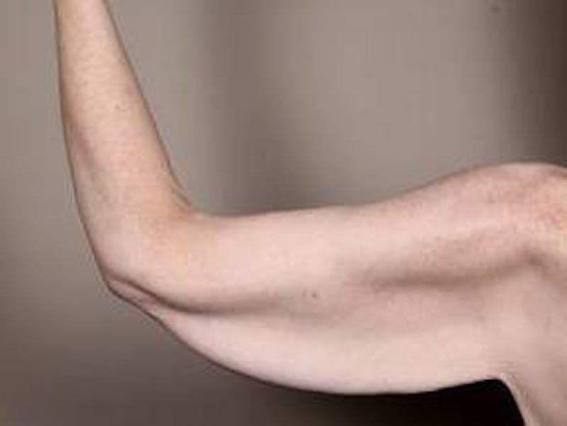 Arm Lift Before & After Gallery - Patient 350294 - Image 3 - Scott Chapin, MD